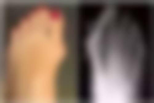 双眼皮修复是不是重新做一次？二次三次能否修复及费用、时间等问题解答