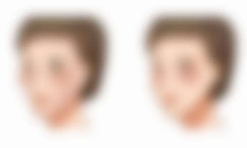 小阴唇缩小手术的价格