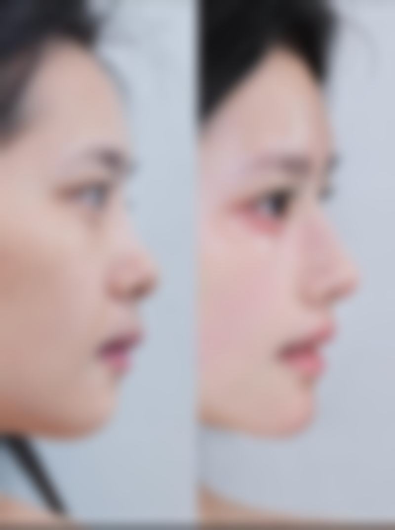 美容院打的除皱针好吗？存在产品、人员等隐患，正规医美机构或许更靠谱