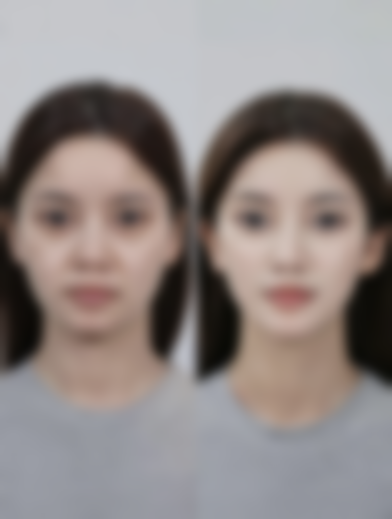 美白针有哪些品牌？姜雨汐、再生美等热门及常见品牌大揭秘 