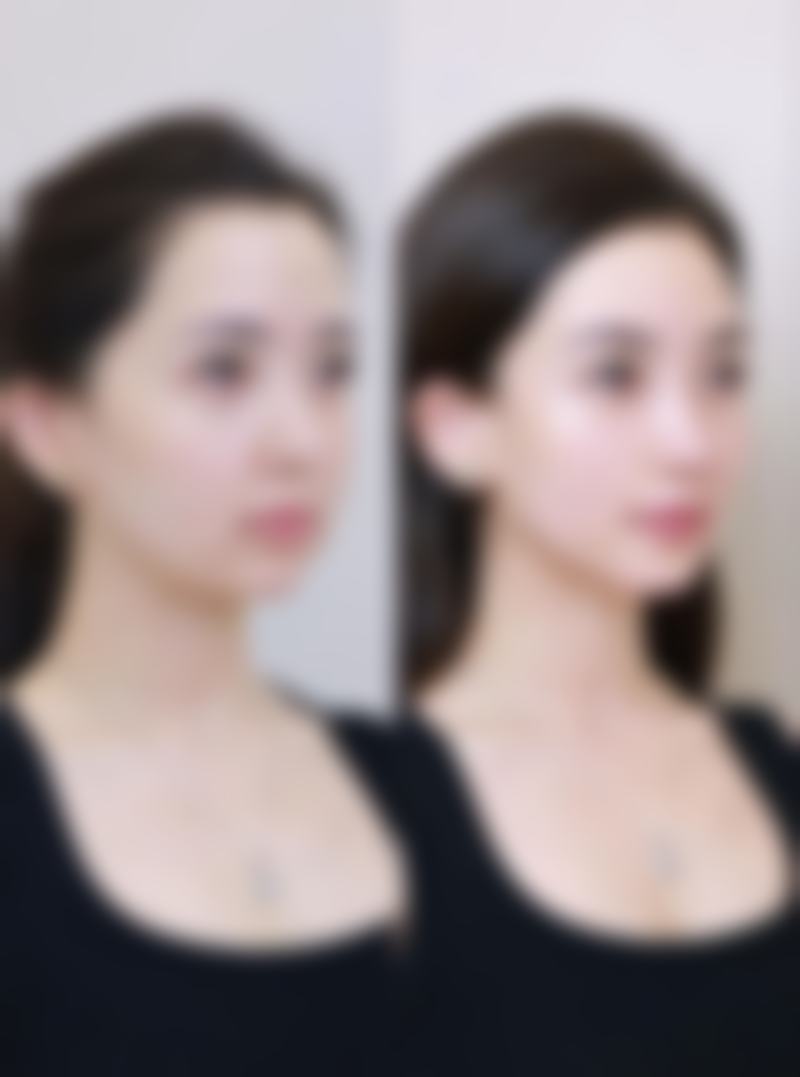 隆胸有什么好处和坏处？好处增体积提自信，坏处有风险价格贵咋选？ 