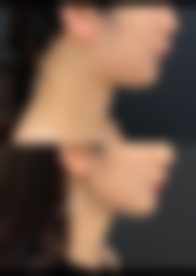 玻尿酸填充丰太阳穴成效好不好