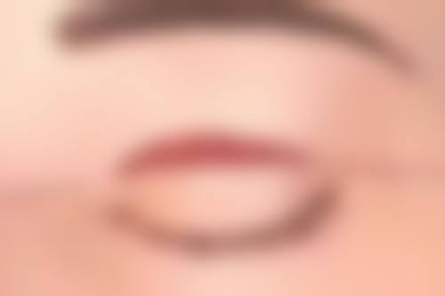 蛋白线隆鼻的成效呈现如何