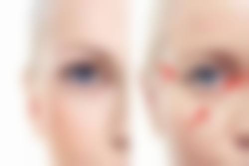 多年的眼袋怎么去除？了解形成原因和多种方法还有价格手术前后要点是关键 