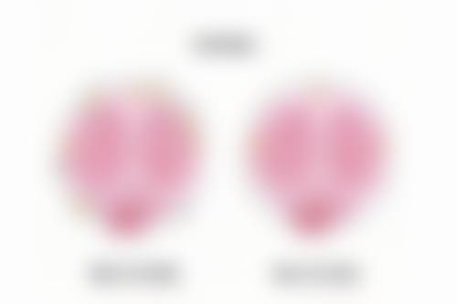 矫正下颚突出的注意事项