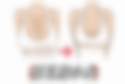 下巴突出需要整形