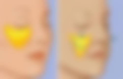 去除多年的眼袋手术前需要注意什么