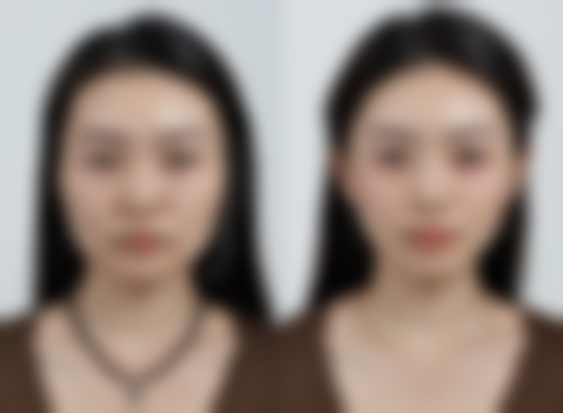 什么丰太阳穴好？自体脂肪、玻尿酸、假体植入、线雕各有啥特点与价格差异 