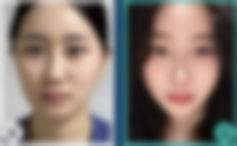 下巴不对称需要整形