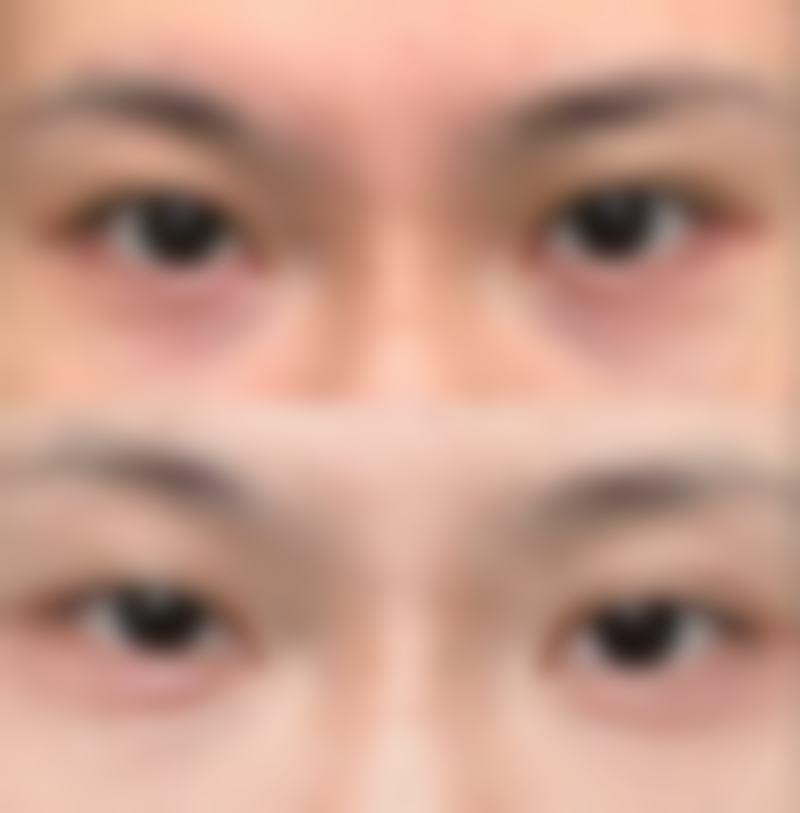 饮食搭配辅助调整下颚后缩