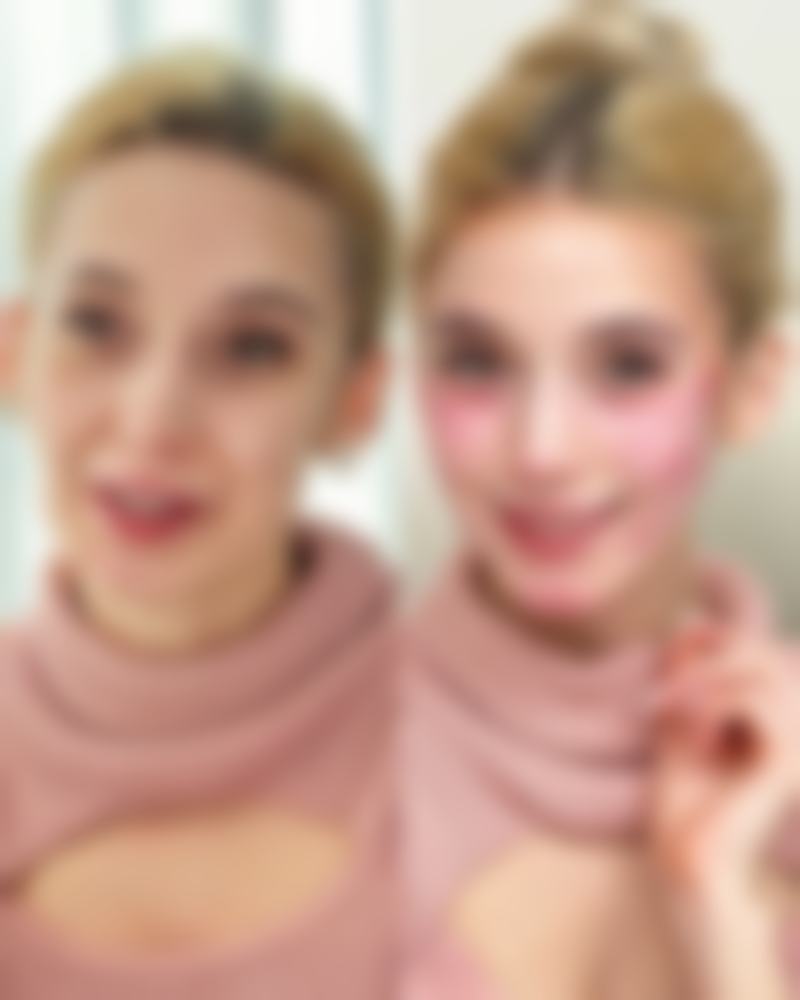 凹陷疤痕如何才能修复？注射、激光、填充、缝合等方法为你排忧解难