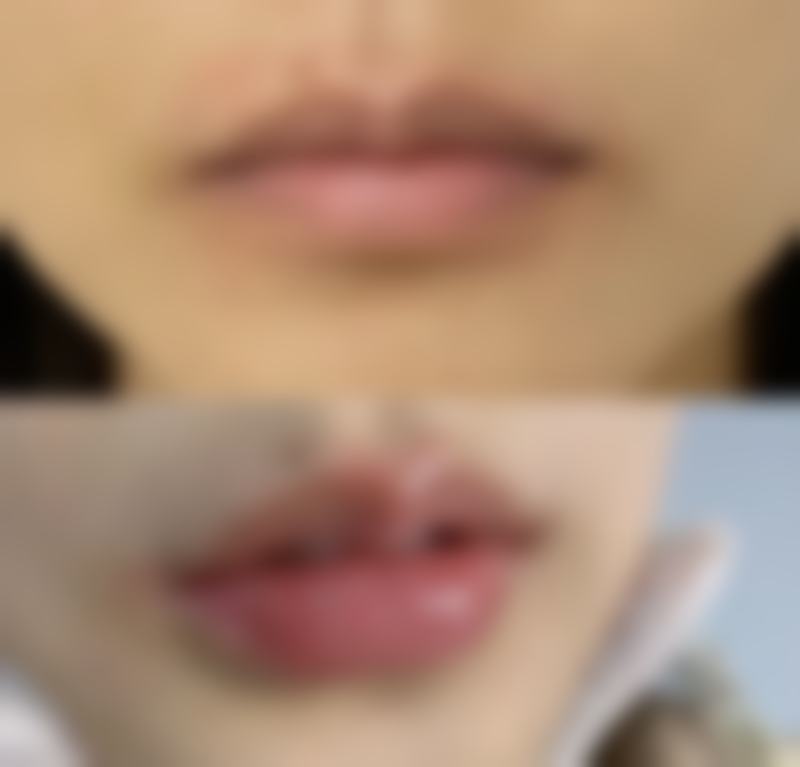 其他影响双眼皮显现的因素