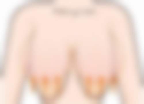 硅胶隆鼻的术后维护