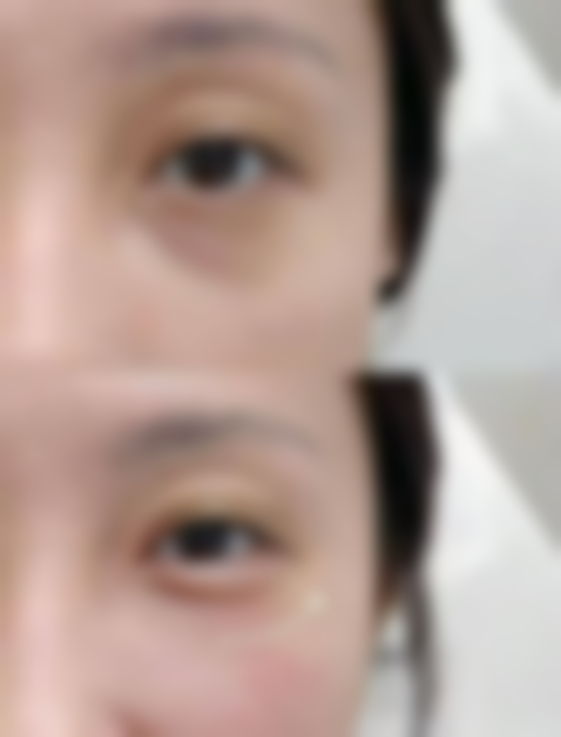 术后管理需要注意什么