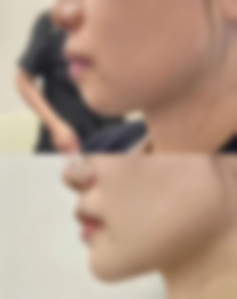 小阴唇缩小手术的修复时间和费用