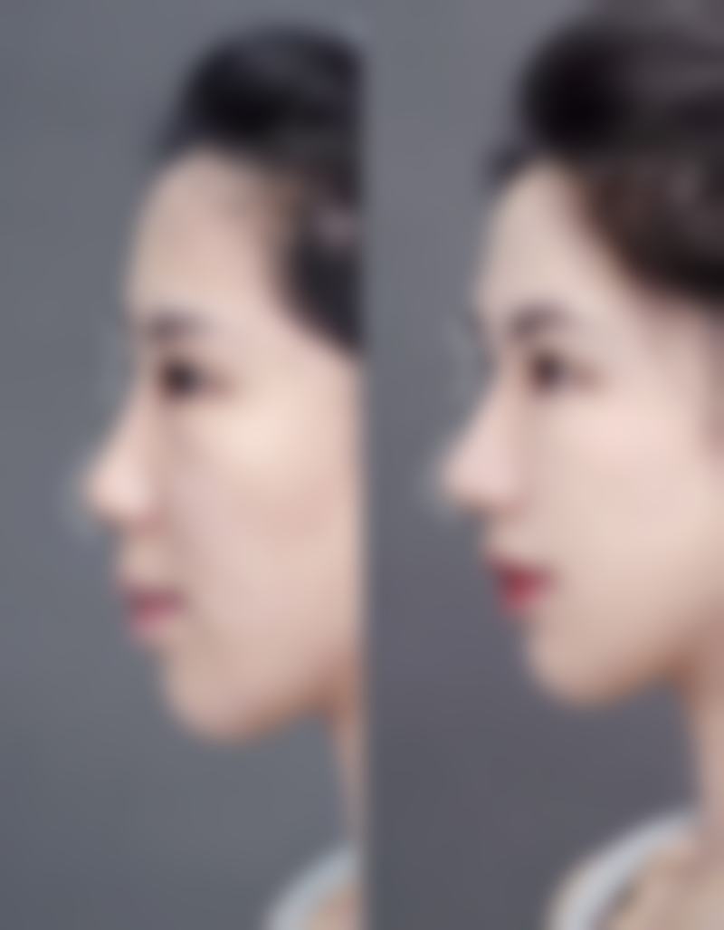 注射胶原蛋白除皱的情况