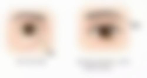 肥胖吸脂手术的成功实例与成效