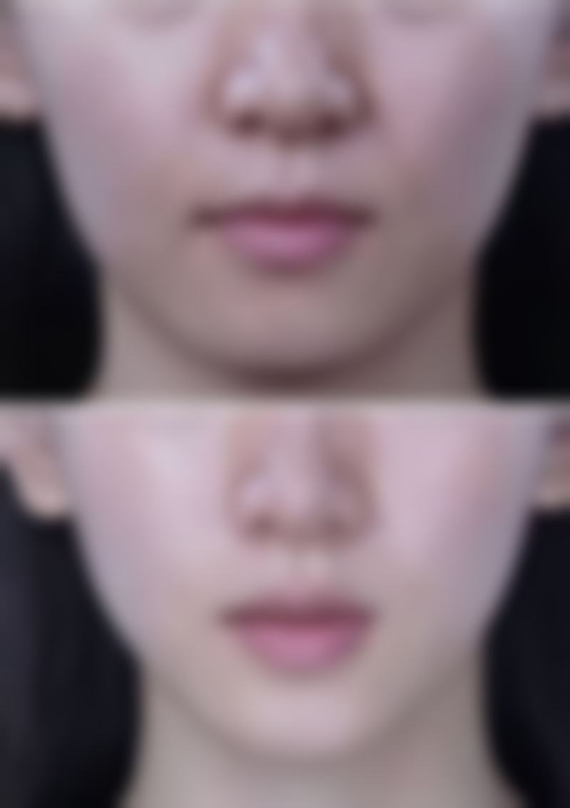 小阴唇缩小手术的费用