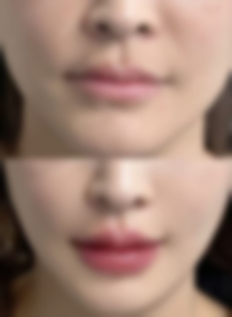 小阴唇缩小手术需要住院吗？多数不用但特殊情况需住，恢复时间费用等也有讲究 