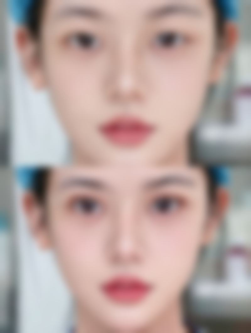 常见建议的美白针注射周期