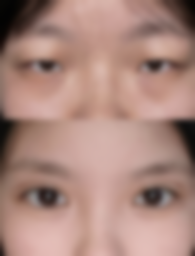 嘴唇上翘怎么整形？多种方法任你选，医院信息及术后护理也别错过