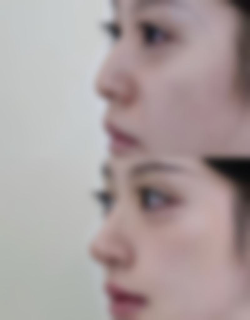 药物治疗白色疤痕