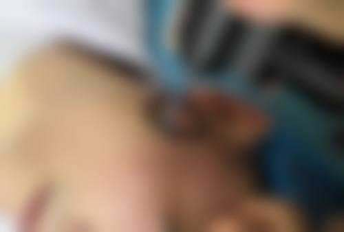 如何判断内吸去眼袋是不是内切