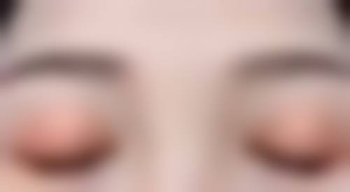 女性阴唇肥大的矫正方法