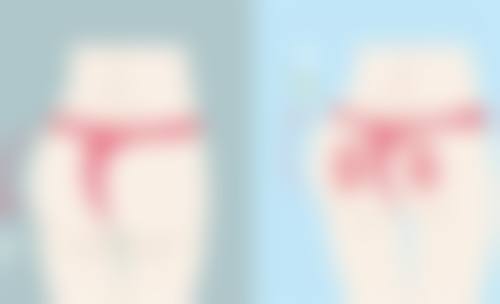 促进自体脂肪丰臀术后消肿的护理建议