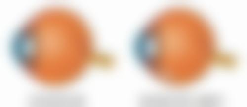 如何降低隆胸手术副作用的发生