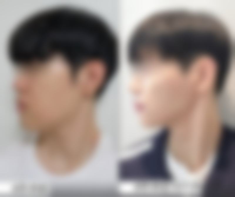 做隆胸手术有什么副作用？血肿、移位等问题咋应对又该如何避免