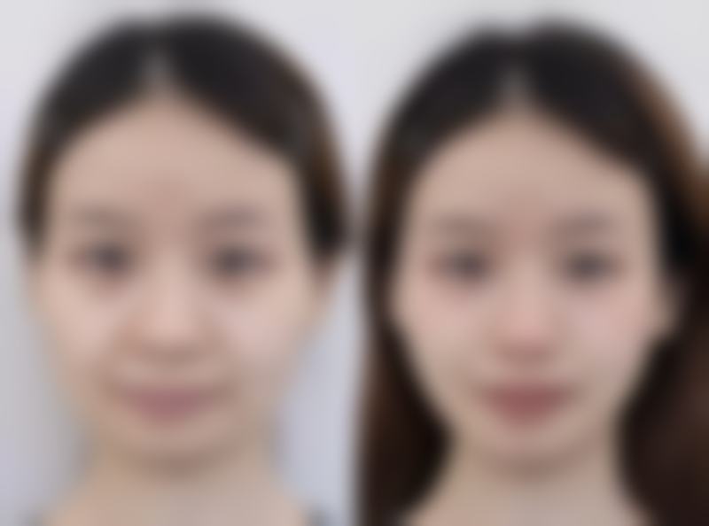 唇部整形手术解决嘴唇突出