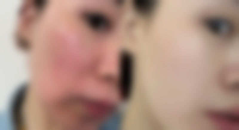 内吸去眼袋和内切去眼袋的不同之处