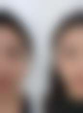 日常护理辅助修复脸上摔的疤痕