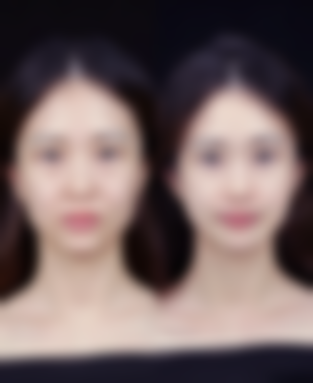 影响下巴整形副作用的因素