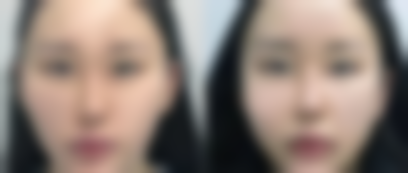 牙齿矫正改善嘴唇突出