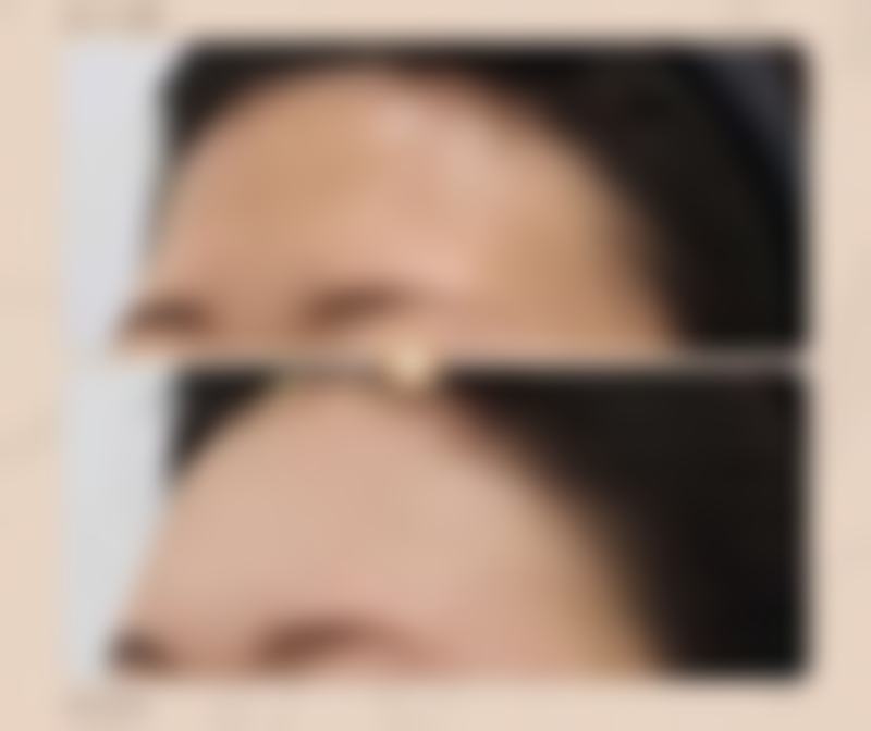 自体脂肪丰臀多久可以消肿？初步消肿1 - 2周完全消肿或需几个月