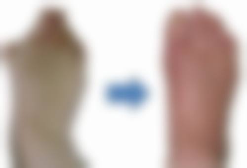 影响玻尿酸填充隆鼻持续时间的因素