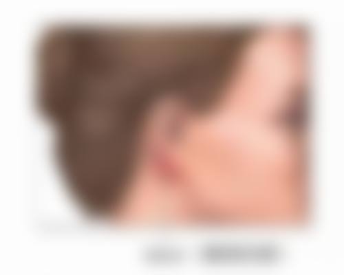 线提升提升丰太阳穴是否适用