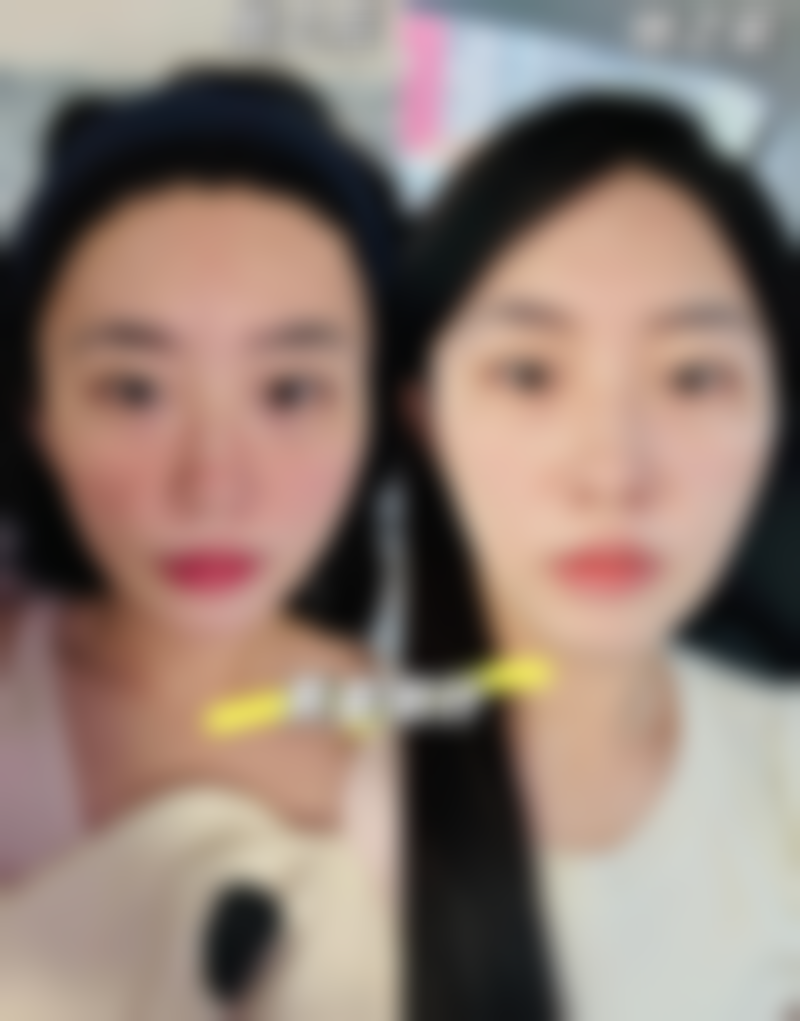 常见的双眼皮疤痕修复具体手段