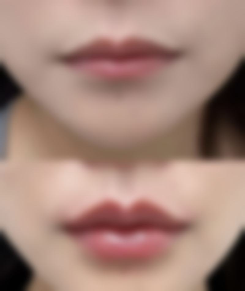 影响注射隆胸材料取出干净与否的因素