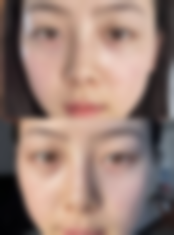 胶原蛋白注射丰太阳穴是否可行