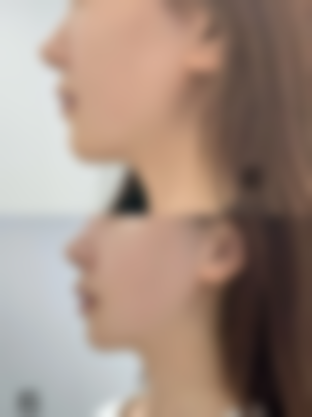 隆鼻后过早抽烟的危害