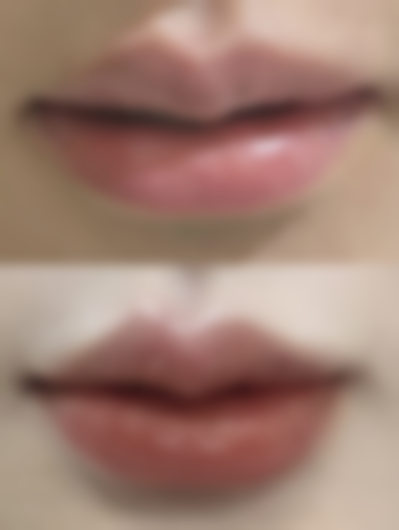 线提升提升丰太阳穴是怎样做的