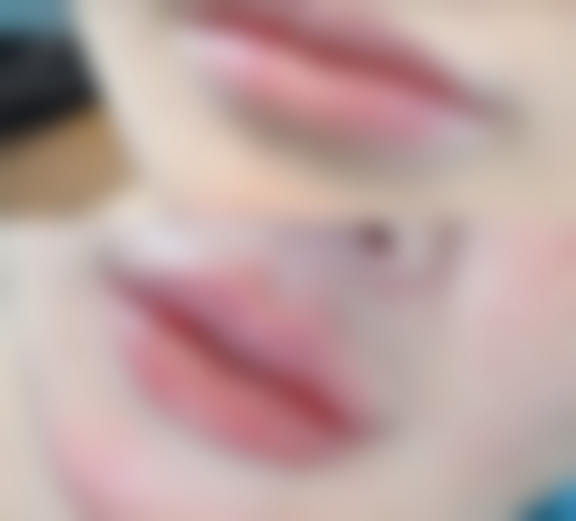 嘴巴翘整形的注意事项有哪些