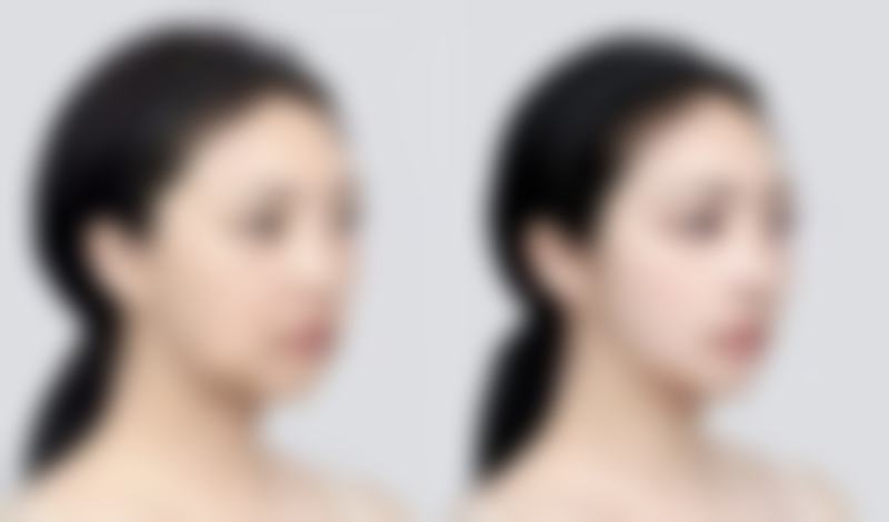 小阴唇缩小手术相关情况