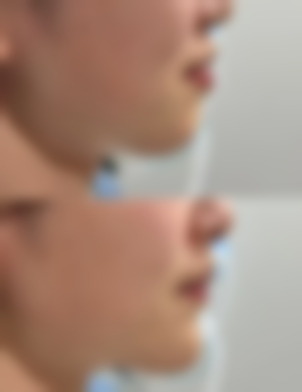 双眼皮手术后的其他注意事项