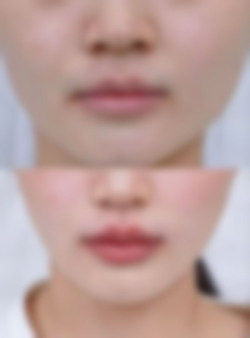 微笑唇整形的手术过程是怎样的