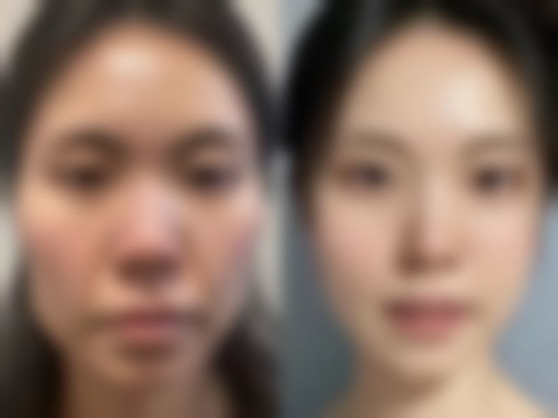 自己毛囊不够怎么办