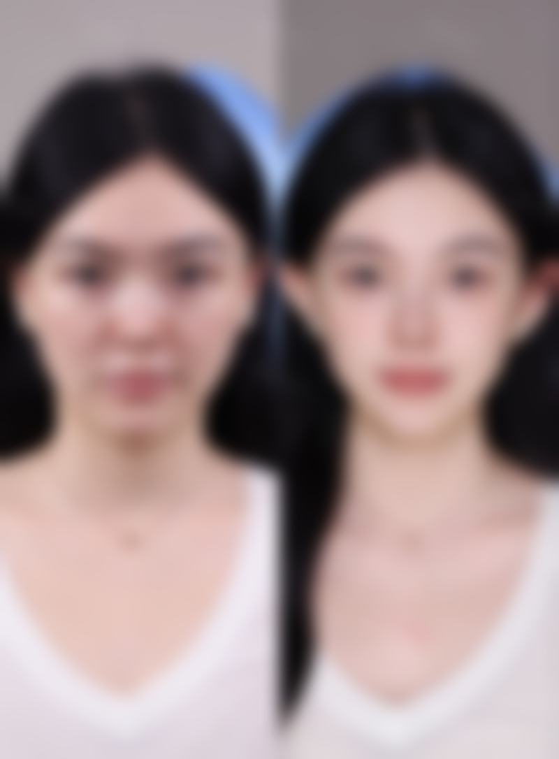 瘦脸针打一针有效吗的总结